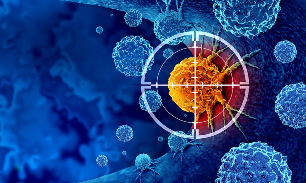 AI, cancer detection, healthcare